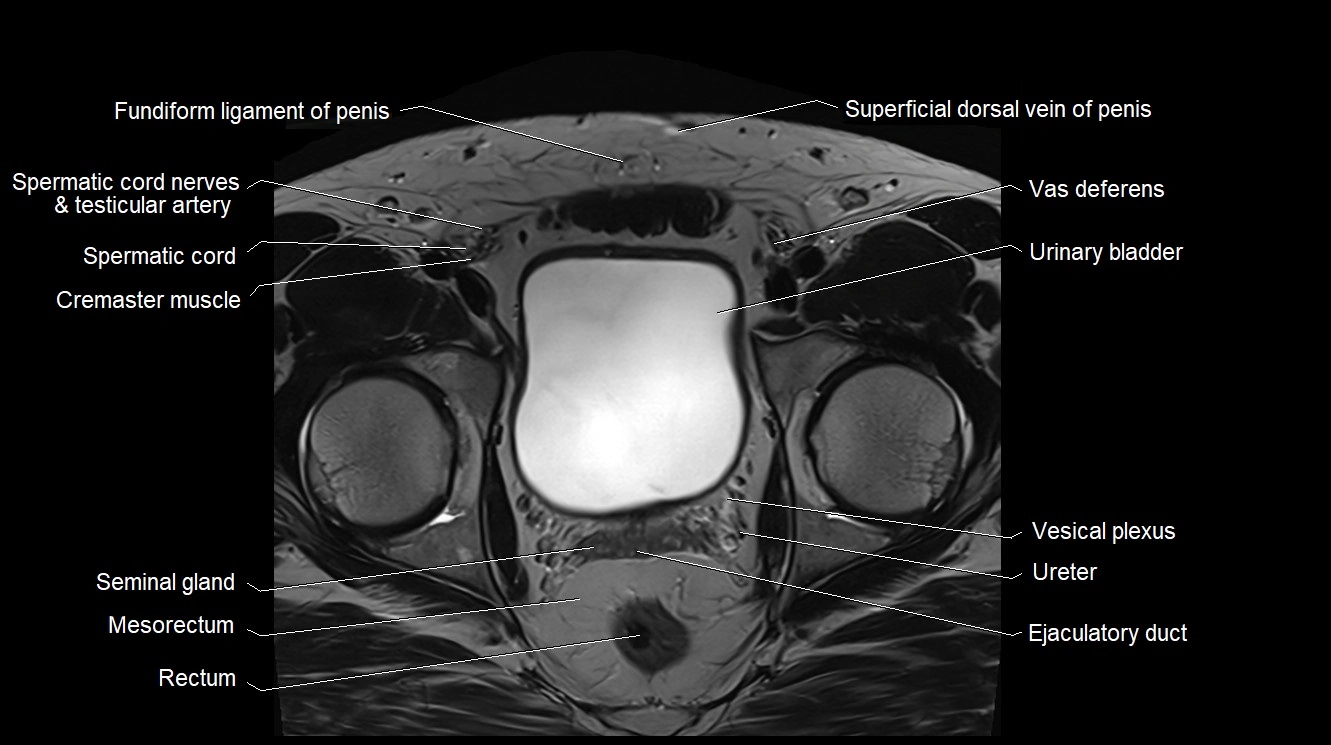 MRI 3T scrotum and penis axial cross sectional anatomy image 2.webp